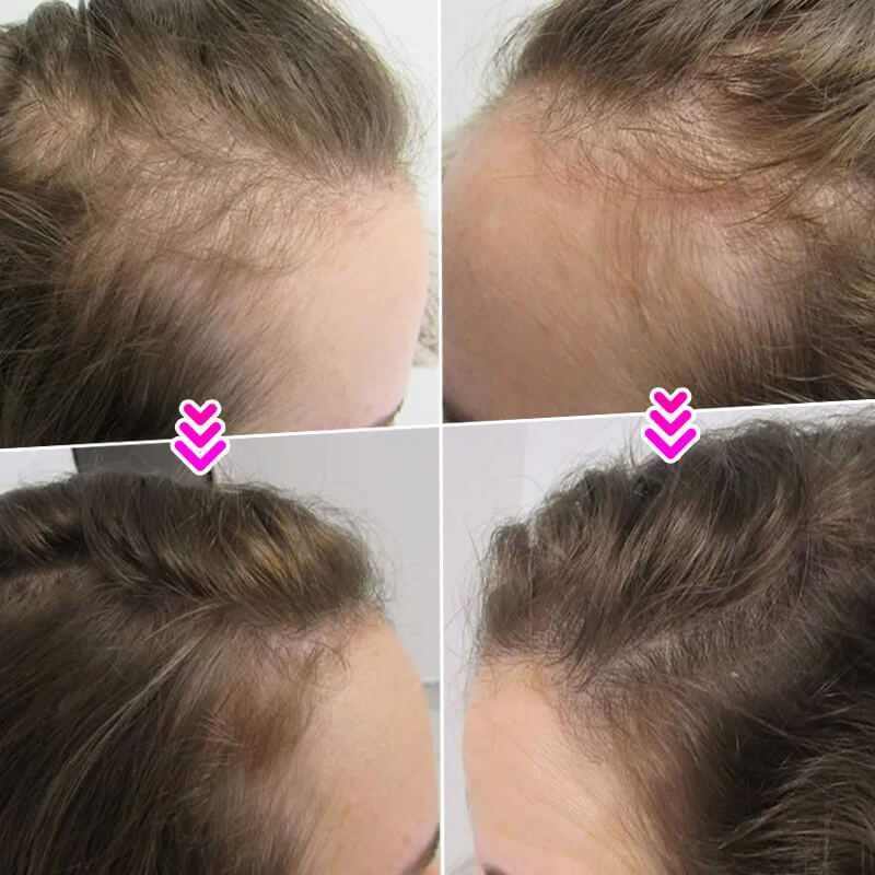 EELHOE HAIR™  Púder hajhullás ellen és a hajvonal gyors feltöltése